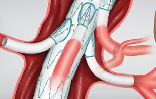 The Zenith t-Branch Thoraco Abdominal Stent Graft from Cook Medical